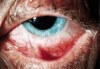 Oko trpící syndromem suchého oka