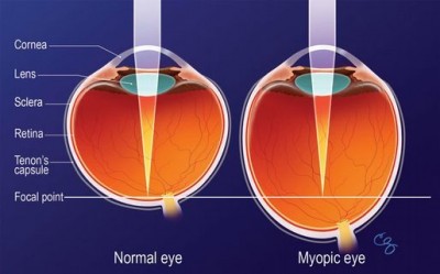 Krátkozraké oko je delší než normální oko