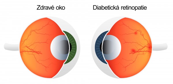 Počet pacientů s diabetickou retinopatií každý rok narůstá.